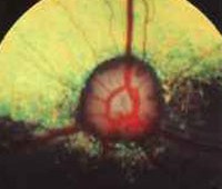 Retina Dysplasi (RD)